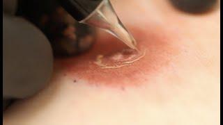 Ink & Pink- 3D Nipple Tattooing: Plastic Surgery Hot Topics with Rod J. Rohrich, MD