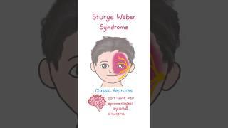 Sturge Weber Syndrome