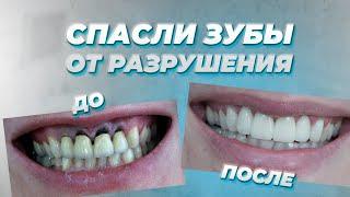 Как мы восстановили разрушенные зубы под коронками? Стоматология Вариант в Самаре