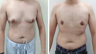 Seroma In Gynecomastia,Technique Matters In Gynecomastia