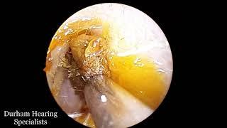 The quickest ear wax removal using microsuction