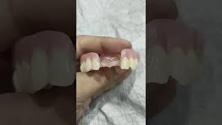 Upper Removable Partial Denture By Haider #rpddentalprocedure #dentalartbyhaider