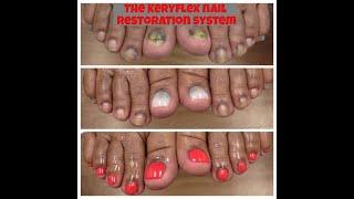 The Keryflex Nail restoration solution for fungal nails.