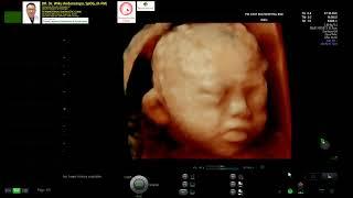 DOWN Syndrome 24 Weeks Trisomi 21 (Dr Wiku Andonotopo)