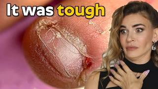 Best Bitten Nails Transformations | Growth & Recovery