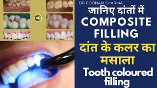 दांत के कलर का मसाला||composite filling या दांत के कलर के मसाला क्या होता है||tooth coloured filling