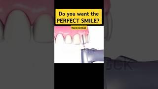 DO YOU WANT THE PERFECT SMILE - VENEERS!? #shorts #dentist #asmrdentist #daant #whitesmile#veneers