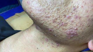 Best Pimple Popping P1 | Mụn Dậy Thì Siêu Hấp Dẫn P1 - SacDepSpa#181