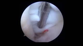 Arthroscopic Excision of a Deep Infrapatellar Cyst