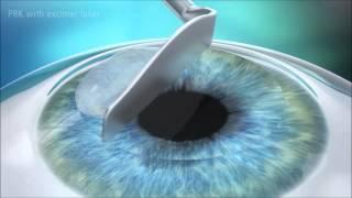 Photorefractive Keratectomy (PRK)