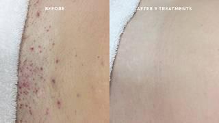 Ingrown Hair Removal Treatment I  After Laser Hair Removal