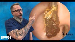 HOW TO SAFELY REMOVE A HUGE EAR WAX PLUG (Earwax removal) - EP991
