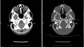 Head CT (computed tomography) radiology search pattern