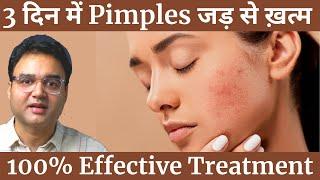 Pimples को बोलो अलविदा | 4 Simple Steps To Remove Pimples & Get Clear, Spotless Skin (Naturally)