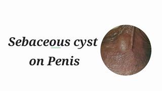 Sebaceous cyst on Penis पेनिस/लिंग पर गांठ