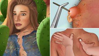 ASMR Treatment pustules caused by cactus thorns animation | Traditional Mexico massage