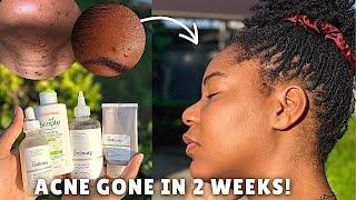 Visibly clearer skin in 2 weeks! Easy 4-step skincare routine 