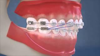 Class II Elastics - Lateral View (HD Edition)