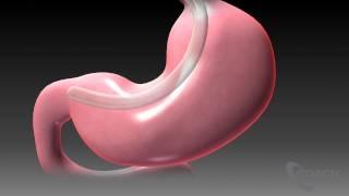 Sleeve Gastrectomy