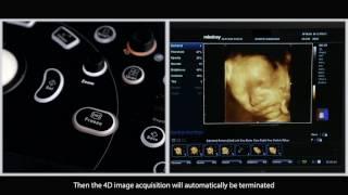 How to Get Perfect 3D/4D Image in your MINDRAY Ultrasound