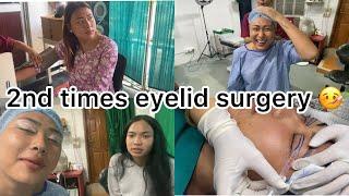 Eyelid surgery second times|| Manne Eidi surgery na yomlabine 