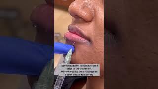 Russian doll filler technique! #botox #filler #dermatologist