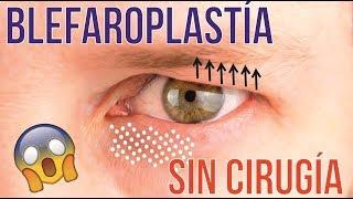 BLEFAROPLASTÍA SIN CIRUGÍA MEDIANTE LASER CO2 FRACCIONADO  DR. ALBERTO CALVO QUIROZ