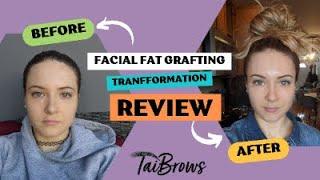 My Facial Fat Grafting Experience with Dr. Motykie