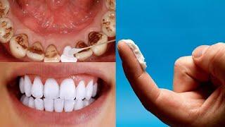Как Можно Отбелить Зубы Дома за 3 дня и Удалить зубной камень не обращаясь к стоматологу Желтые зубы