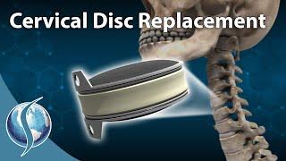 Cervical Disc Replacement