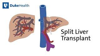 Split Liver Transplant Saves Two Lives with One Organ | Duke Health