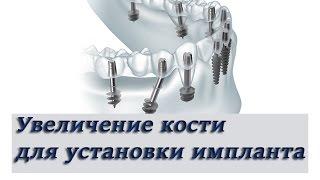 Увеличение кости перед установкой импланта  Протезирование  Имплантология  Стоматология