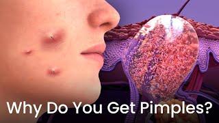 Why You Get Pimples - 3D Animated!