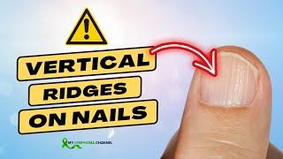 What Causes Vertical Ridges on Nails