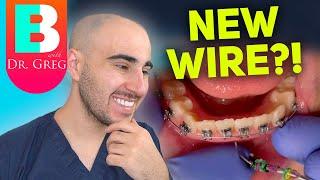 Braces Wire Tightening - Why & How Your Orthodontist Changes Your Braces Wires