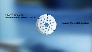 MTP S-Core® Platform Technology | Subchondral Solutions