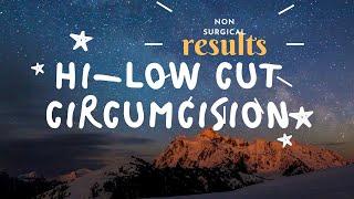 Results of Hi vs Low vs Standard Cut Circumcision  Dr.Sachin Kuber Call US +919850063926