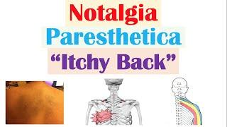 Notalgia Paresthetica (“Itchy Back”) | Causes, Risk Factors, Symptoms, Diagnosis, Treatment