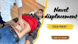 Navel displacement treatment in india