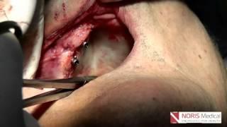 Zygomatic Implant Video - Noris Medical