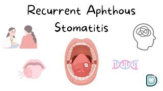 Understanding Recurrent Aphthous Stomatitis (RAS) or Oral Aphthous Ulcers