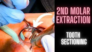 Surgical Extraction of a Maxillary 2nd Molar | Tooth Sectioning | OnlineExodontia.com