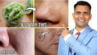 Get Rid Of Dark Spots, Open pores , Blackheads  Naturally at Home - Dr. Vivek Joshi