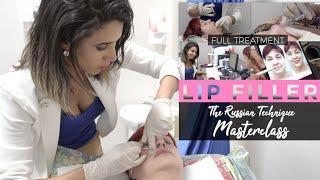 Advanced RUSSIAN Lip Filler Techniques | Full Treatment with Before and After 