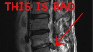 How to Read a Spine MRI