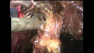 COMBINED VAGINAL-LAPAROSCOPIC-TRANSANAL APPROACH IN LARGE DEEP ENDOMETRIOTIC NODULES OF THE RECTUM