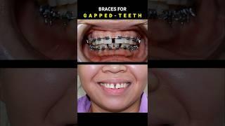 BRACES FOR GAPPED TEETH. 32 MONTHS DURATION #braces #orthodontist #dentist