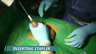 ZSR Stapler Circumcision | Circumcision Surgery By Dr.Ashutosh Shah in Vesu, Piplod, Surat