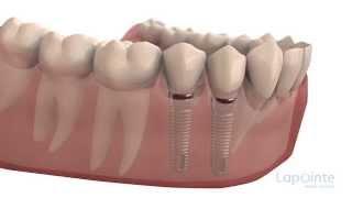 Implants - Lapointe dental centres