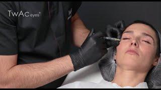 TwAc eyes - elimination of dark circles under the eyes, reduction of puffiness